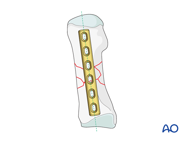 Plate positioning for bridge plating of a multifragmentary diaphyseal fracture of the 1st metatarsal