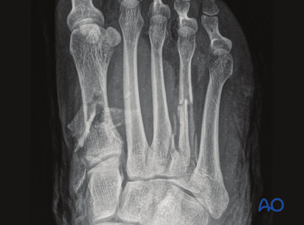 There are injuries to the 1st through 4th metatarsals, with an open dorsal soft tissue wound. 