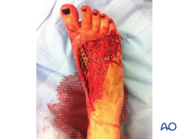Debridement and plating of the first metatarsal