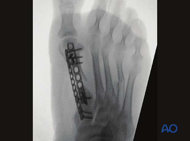 This AP X-ray shows double plating of the first metatarsal with satisfactory reduction of the 2nd – 4th rays