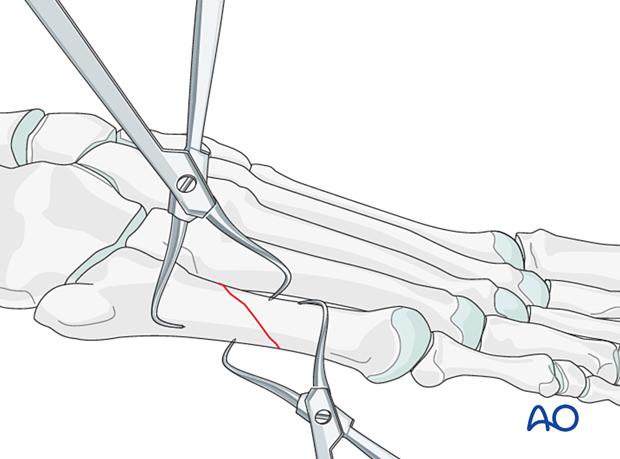 Reduction of an oblique fracture of the 5th metatarsal with reduction forceps