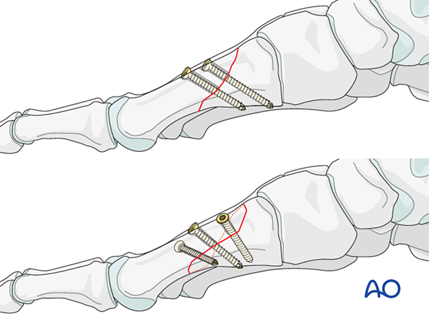 Lag screw fixation of an oblique fracture of the 1st metatarsal