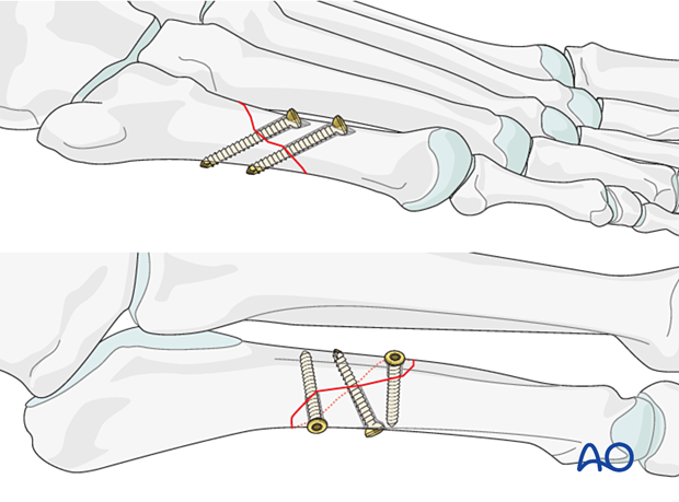 Lag screw fixation of an oblique fracture of the 5th metatarsal