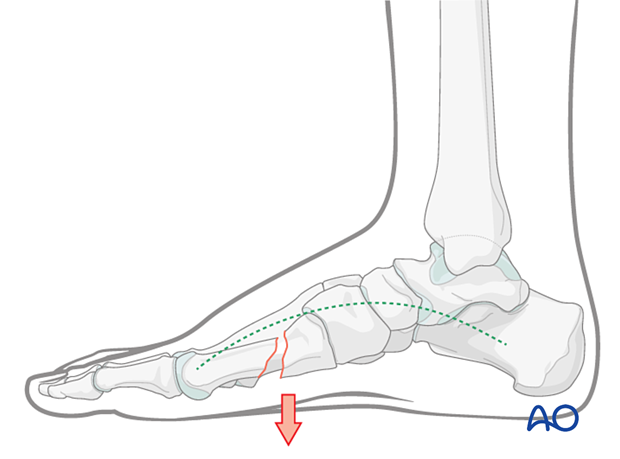 Malreduction of the 1st metatarsal fracture