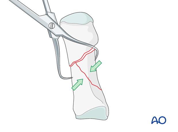 Reduction of the wedge fragment of the 1st metatarsal to one of the main fragments with a reduction forceps