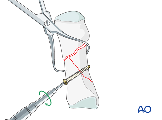 Screw fixation of the wedge fragment of the 1st metatarsal to one of the main fragments