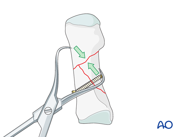 Reduction of a 1st metatarsal fracture with reduction forceps