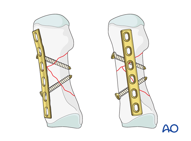Plate positioning for ORIF of a wedge 1st metatarsal fracture with lag screw an neutralization plate