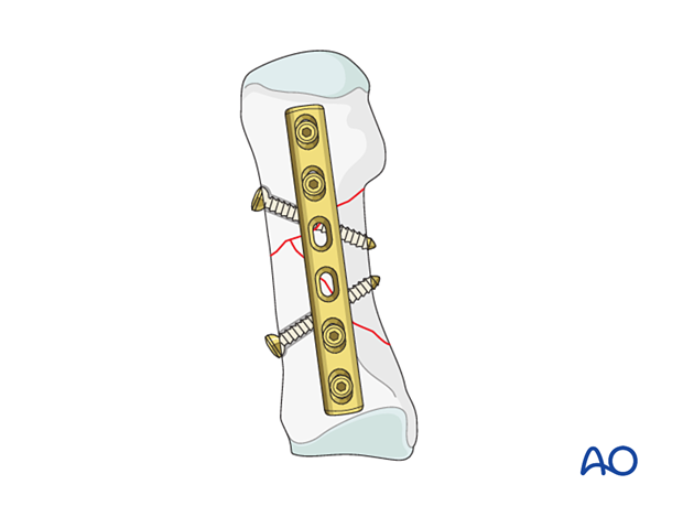 Lag screw and neutralization plate fixation of an wedge fracture of the 1st metatarsal
