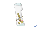 Compression plate fixation of a wedge proximal diaphyseal metatarsal fracture with a T-plate