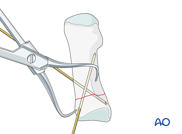 Reduction and preliminary fixation of a proximal transverse fracture of the first metatarsal