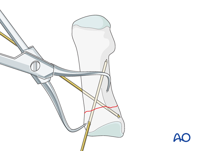 T Fixator Examples T-plate fixation with compression for Simple diaphyseal and proximal ...