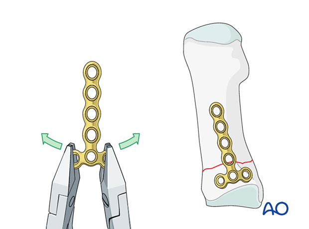 Bending and contouring of a T-plate for fixation of a proximal transverse metatarsal fracture
