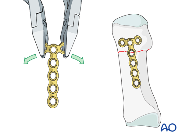 Bending and contouring of a T-plate for fixation of a distal transverse metatarsal fracture