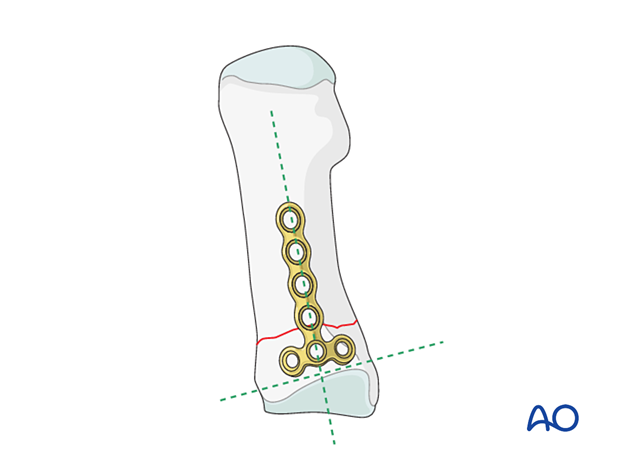Placing a T-plate for fixation of a proximal transverse metatarsal fracture