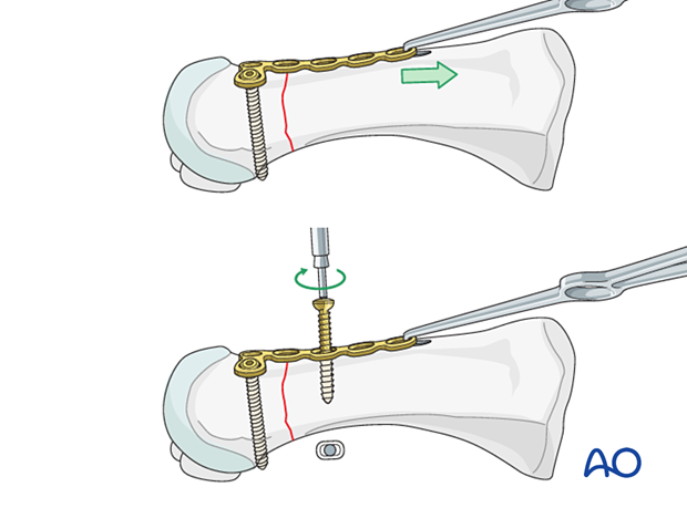 Compression with a small bone hook for plate fixation of a distal transverse metatarsal fracture