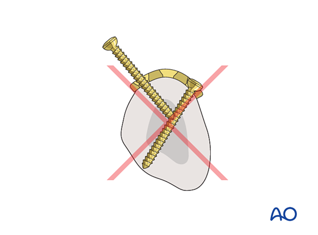 Convergent screws inserted in the transverse portion of a T-plate may block each other