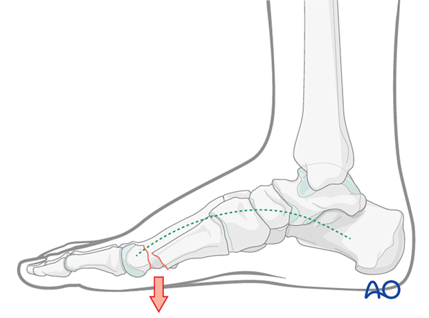 Malreduction of the 1st metatarsal fracture