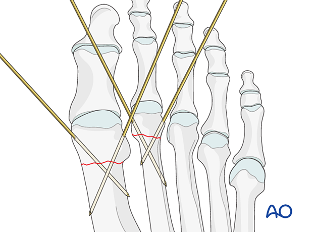 K-wire fixation of a distal extraarticular fracture of the 1st and 2nd metatarsal