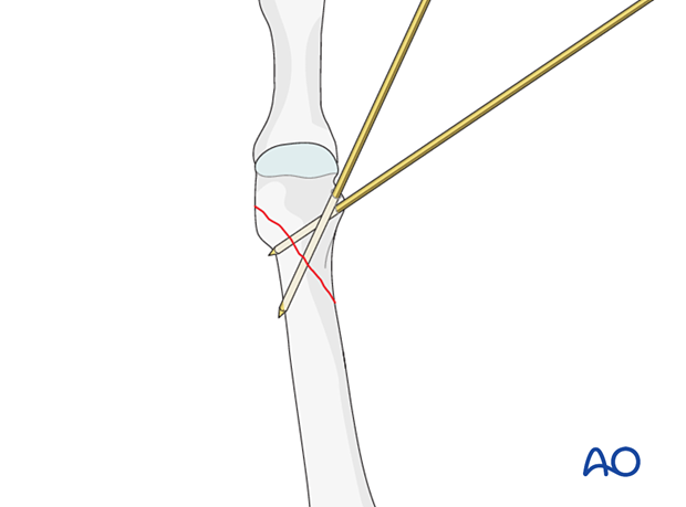 K-wire fixation of a distal extraarticular metatarsal fracture