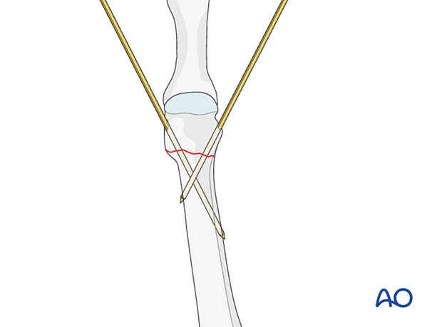 K-wire fixation of a distal extraarticular metatarsal fracture