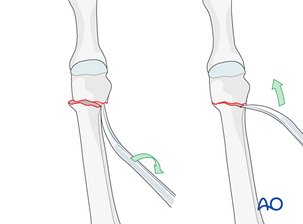 Reduction of a distal extraarticular metatarsal fracture with a periosteal elevator