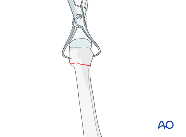 Reduction of a distal extraarticular metatarsal fracture with reduction forceps