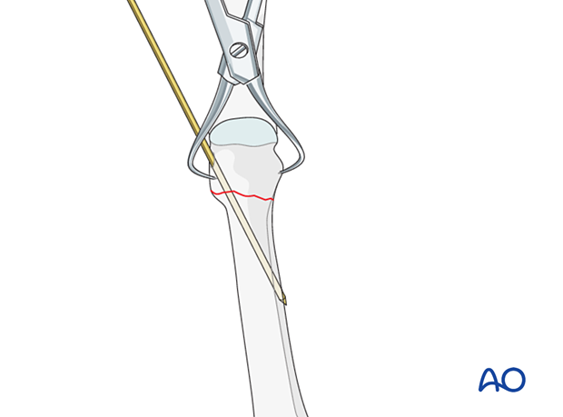 Insertion of a K-wire for fixation of a distal extraarticular metatarsal fracture