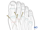 K-wire fixation of a distal extraarticular fracture of the 2nd metatarsal