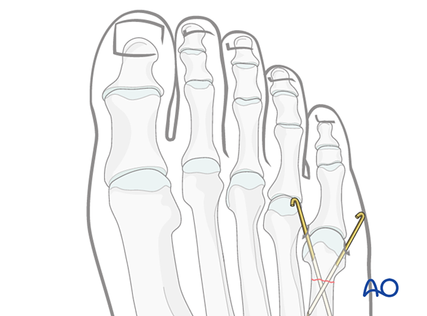 K-wire fixation of a distal extraarticular fracture of the 5th metatarsal