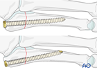 Intramedullary screw and lag screw fixation of a proximal articular fracture of the 5th metatarsal