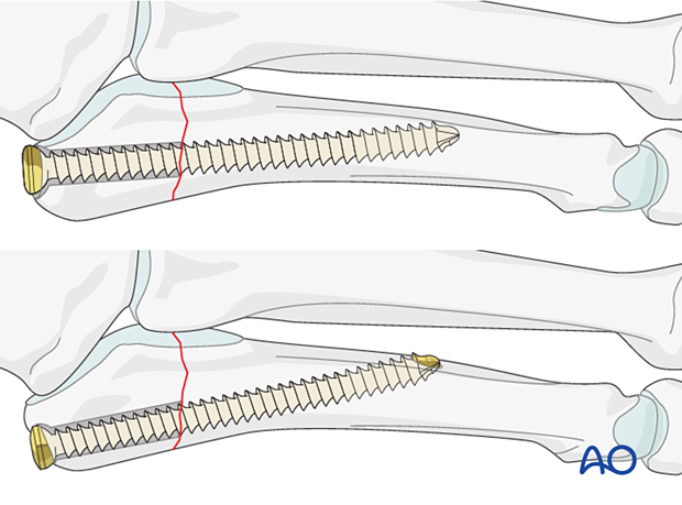 Intramedullar screw fixation of a proximal articular fracture of the 5th metatarsal