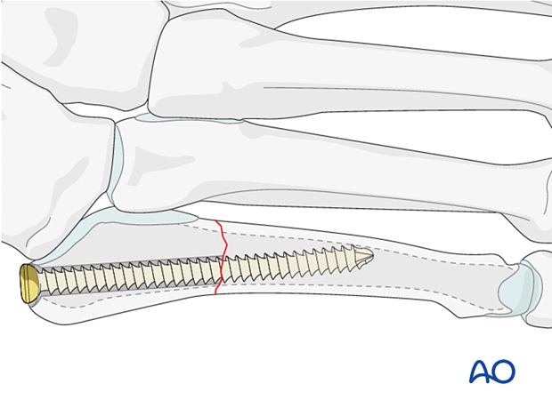Intramedullar screw fixation of a proximal extraarticular fracture of the 5th metatarsal