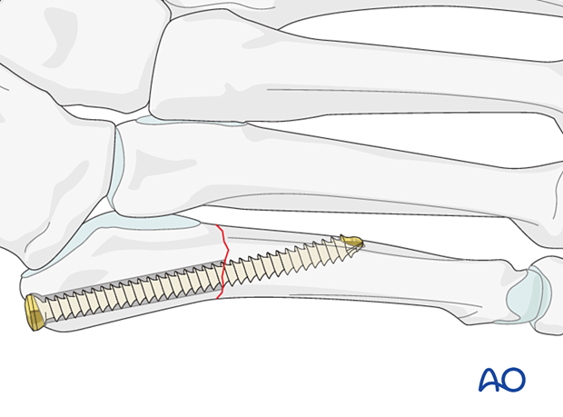 Intramedullar screw fixation of a proximal extraarticular fracture of the 5th metatarsal