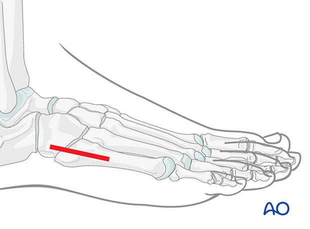 Skin incision for a lateral approach to the fifth metatarsal