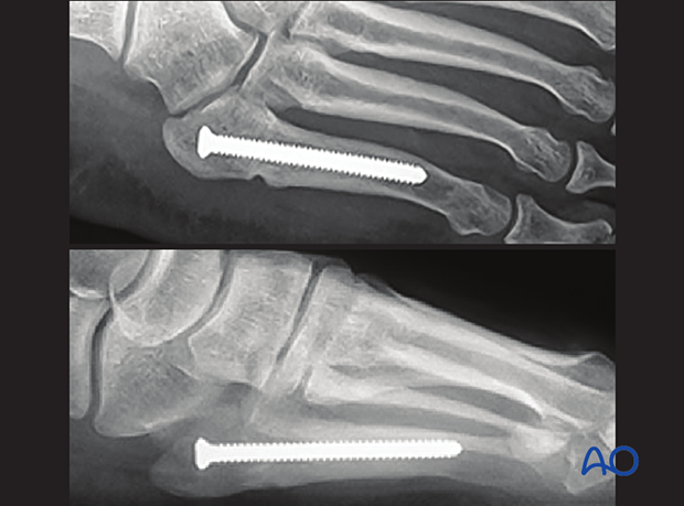 Intramedullar screw fixation of a proximal extraarticular fracture of the 5th metatarsal