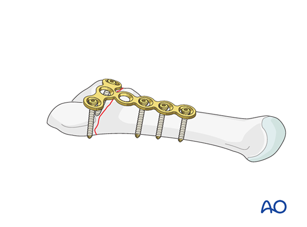 Fixation of an articular fracture of the proximal 5th metatarsal with a T-plate