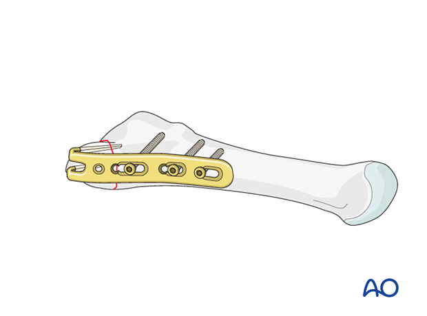 Fixation of an avulsion fracture of the proximal 5th metatarsal with a hook plate