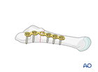 Plate fixation of a proximal extraarticular fracture of the 5th metatarsal