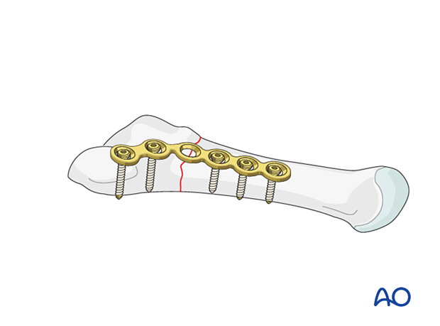 Fixation of an extraarticular fracture of the proximal 5th metatarsal with a straight plate