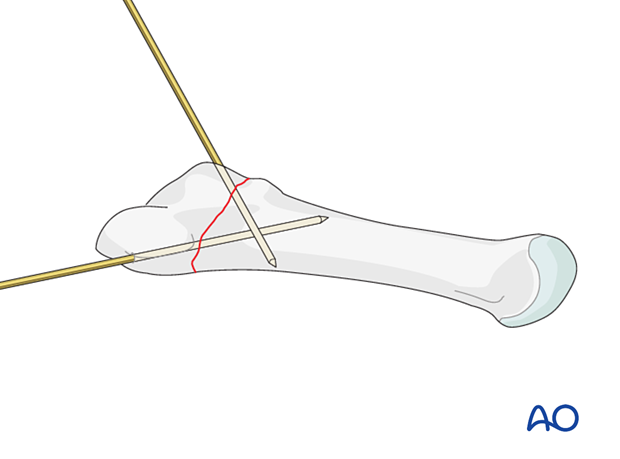 Preliminary fixation with K-wires of an articular fracture of the proximal 5th metatarsal