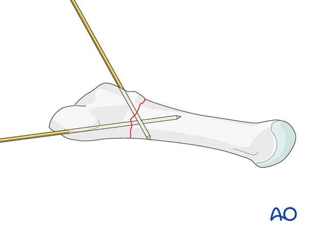 Preliminary fixation with K-wires of an extraarticular fracture of the proximal 5th metatarsal