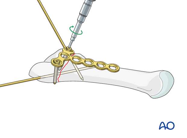 Insertion of a screw into the articular block for plating of an articular fracture of the proximal 5th metatarsal