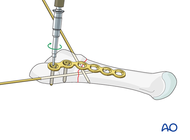 Insertion of a screw into the articular block for plating of an extraarticular fracture of the proximal 5th metatarsal