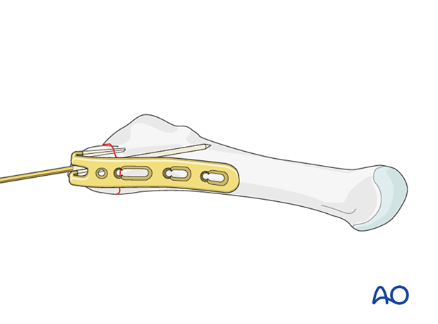 Application of a hook plate for fixation of an avulsion fracture of the proximal 5th metatarsal