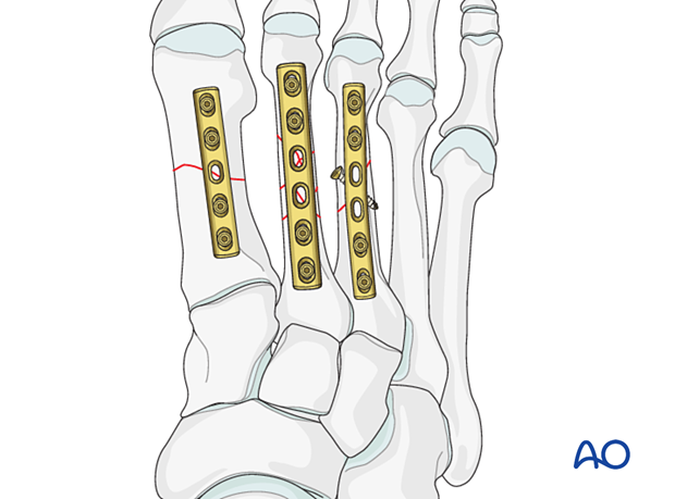 Plate fixation of the 1st–3rd metatarsal fractures
