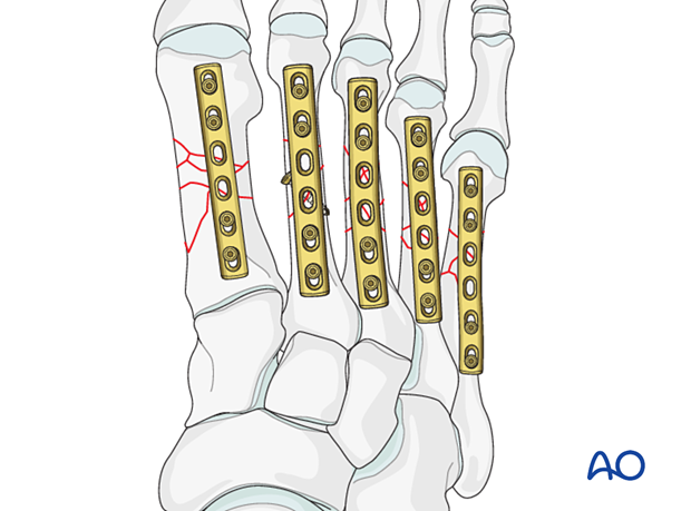 Plate fixation of multiple metatarsal fractures