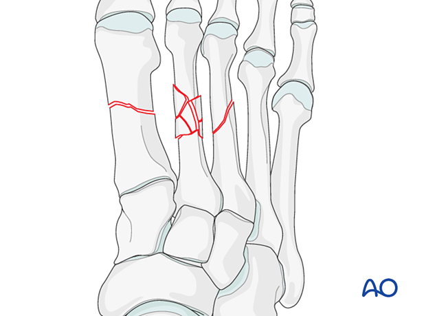 Fractures of the 1st–3rd metatarsals