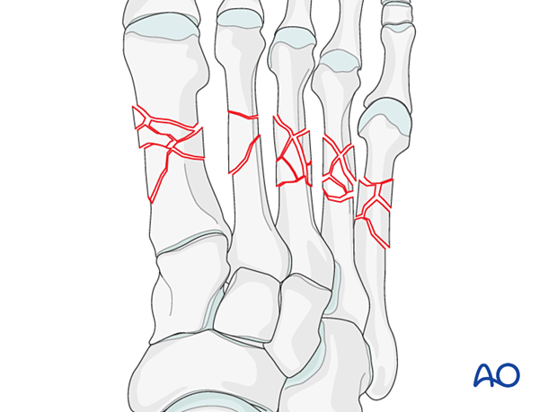 Fractures of all metatarsals