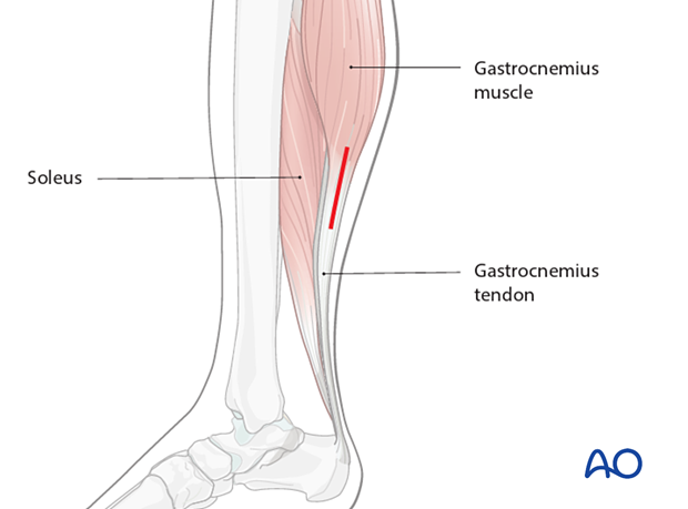 Skin incision for release of the gastrocnemius equinus